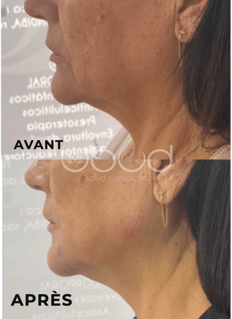 Antes y después de marcación mandibular en Centro Ubud Torremolinos