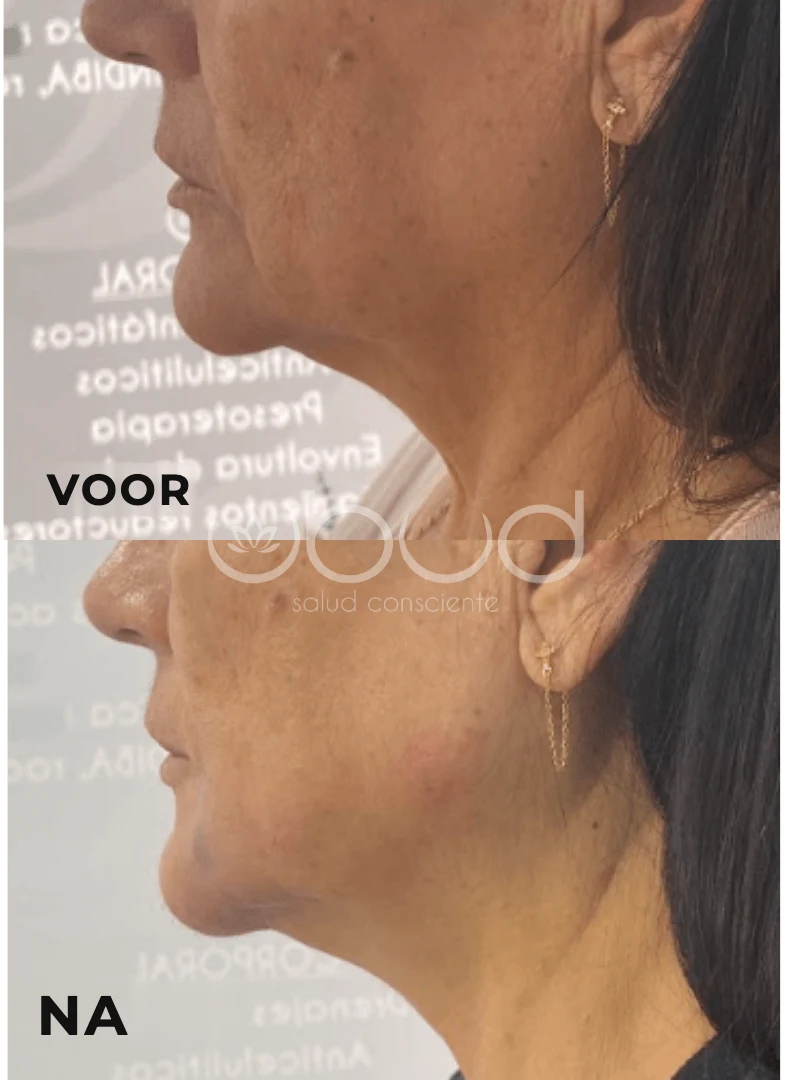 Antes y después de marcación mandibular en Centro Ubud Torremolinos
