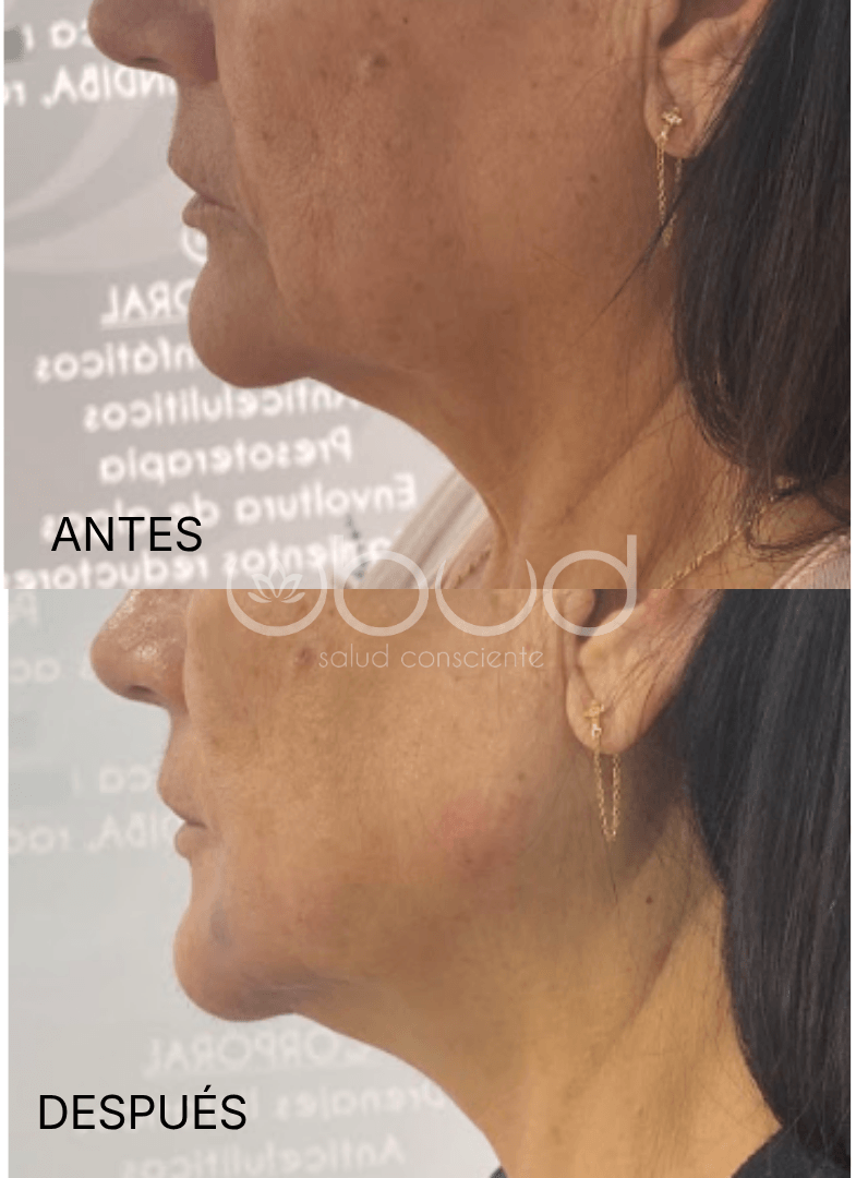 Antes y después de marcación mandibular en Centro Ubud Torremolinos