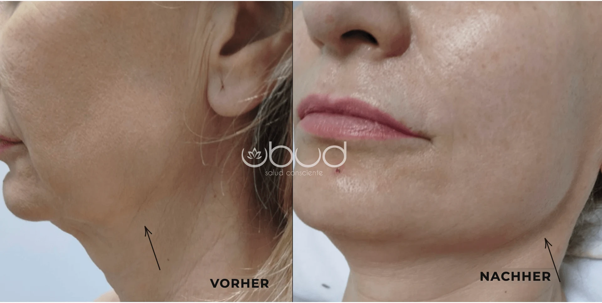 Antes y después de marcación mandibular en Centro Ubud Torremolinos