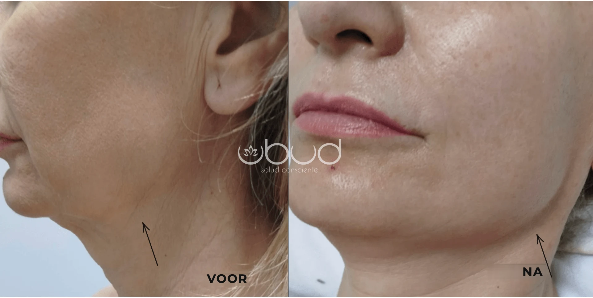 Antes y después de marcación mandibular en Centro Ubud Torremolinos