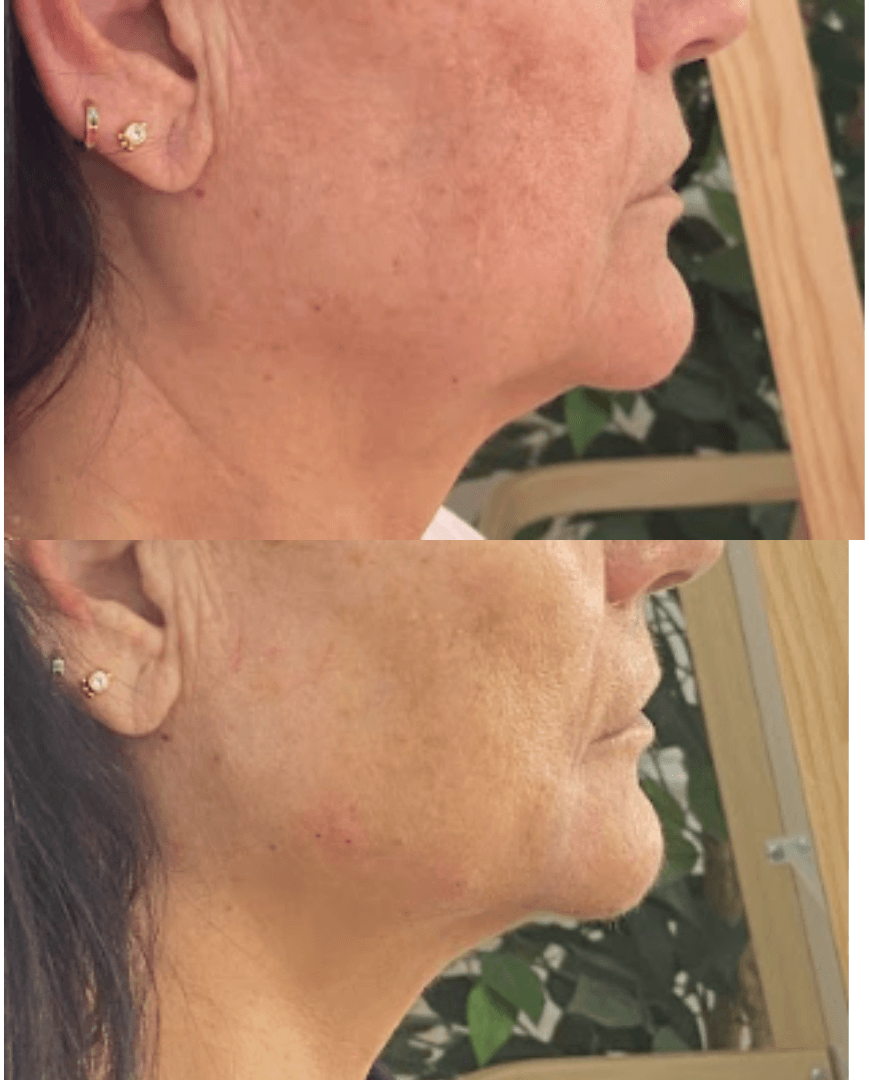 Antes y después de marcación mandibular en Centro Ubud Torremolinos