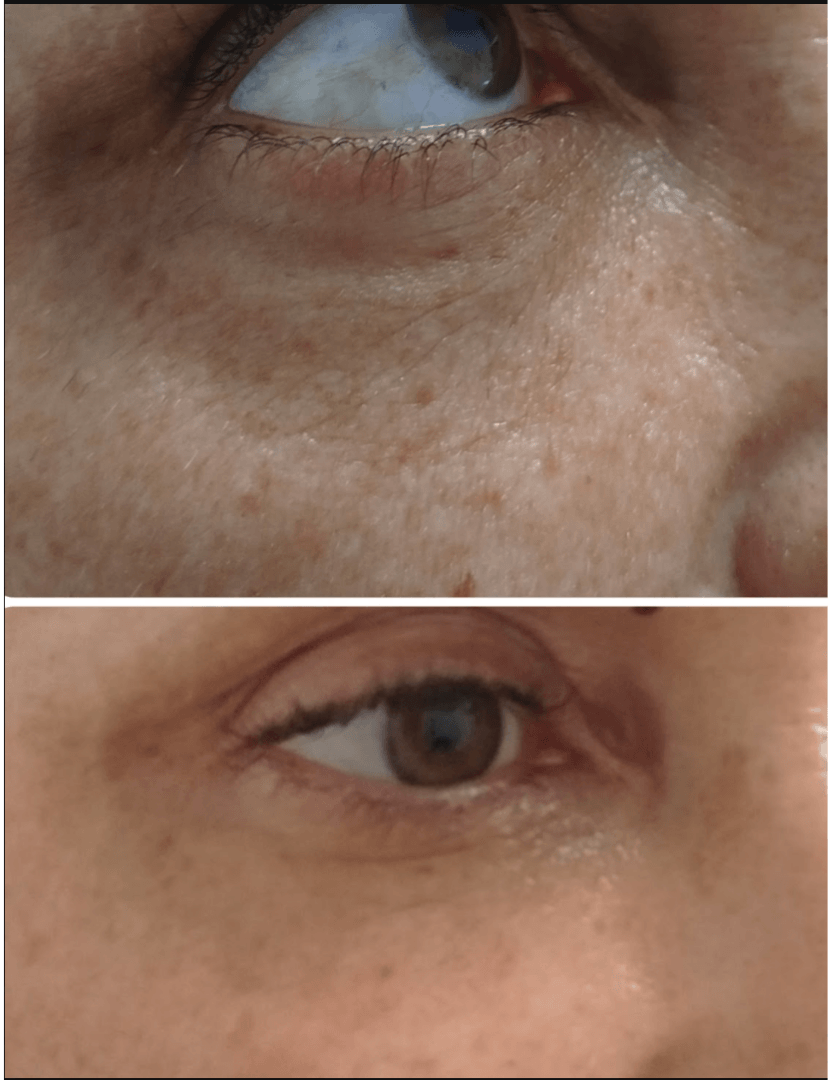 Antes y después de ojeras en Centro Ubud Torremolinos