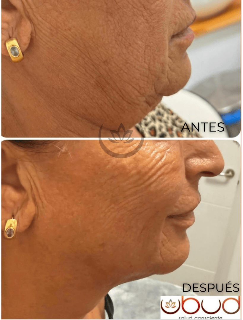 Antes y después de papada en Centro Ubud Torremolinos