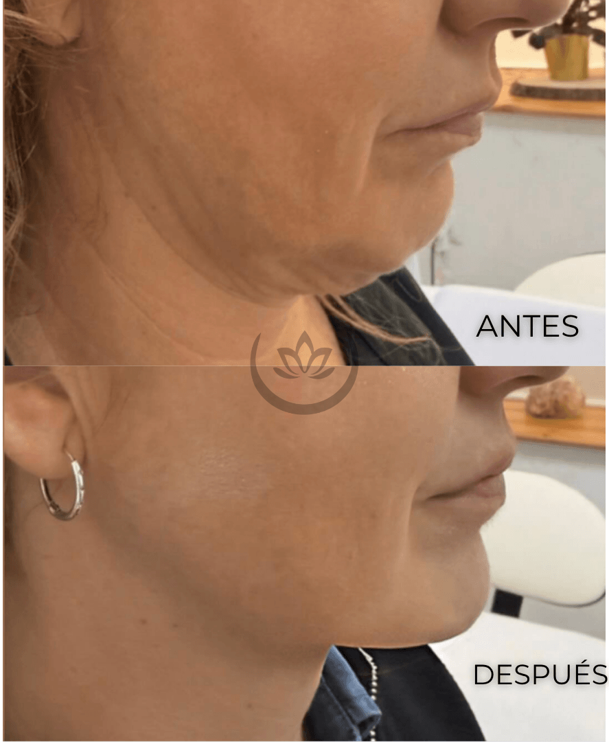 Antes y después de papada en Centro Ubud Torremolinos
