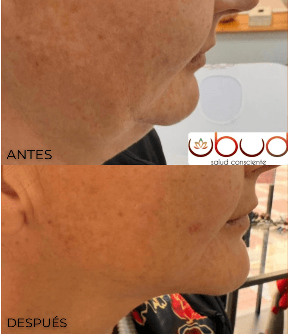Antes y después de papada y marcación mandibular en Centro Ubud Torremolinos